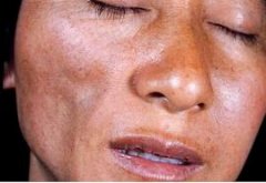 什么是面部肌肉萎缩?