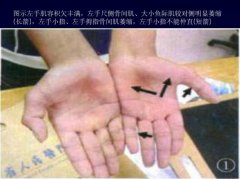 平山病的发病原因有哪些？