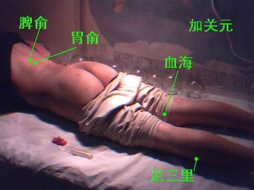 肌营养不良症的针灸治疗方法[点击放大]