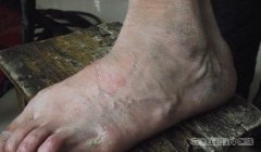末梢神经炎是啥样的？